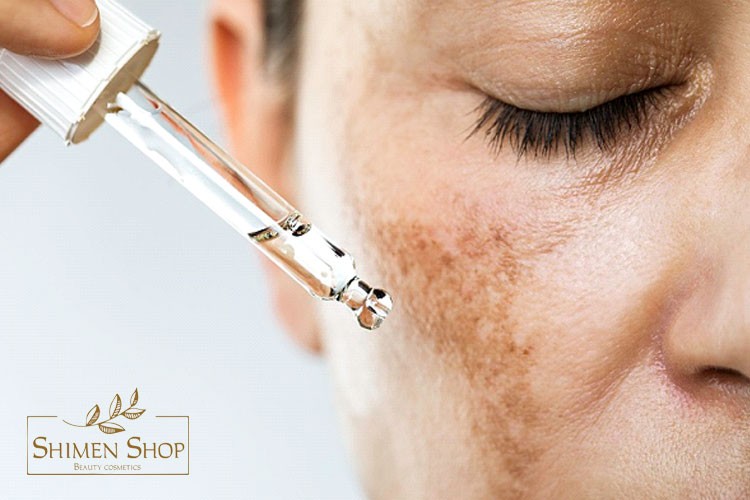 چگونه از ایجاد لک پوستی جلوگیری کنیم؟